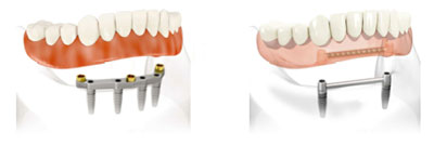 Dr. Mika - Dental Implants