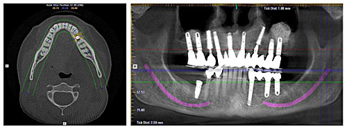 Dr. Mika - Dental Implants